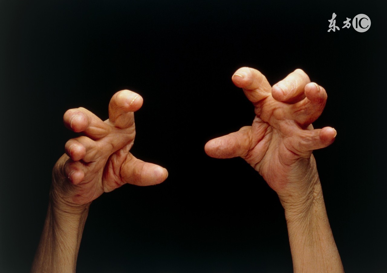 类风湿严重的病人可以吃鱼吗,多吃什么对关节炎有好处