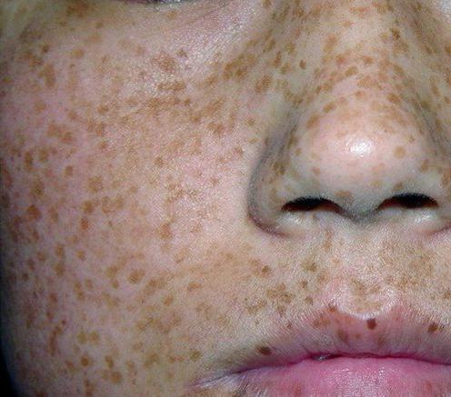 10岁的女孩脸上长斑是什么原因,12岁男孩脸上长斑是什么原因