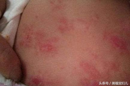 宝宝得了湿疹了怎么办？妈妈们不要慌，这样处理