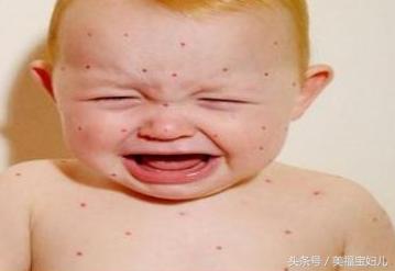 宝宝得了湿疹了怎么办？妈妈们不要慌，这样处理