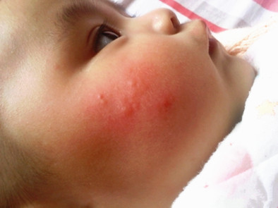 婴儿被蚊子叮咬起水泡需要处理吗,婴儿被蚊子叮咬后红肿硬起小水泡