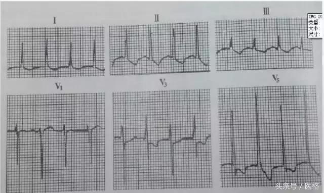 电交替,电交替现象临床意义
