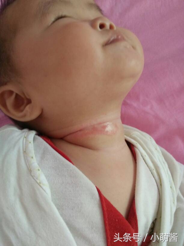 宝宝容易淹脖子怎么办,宝宝已经淹脖子怎么办