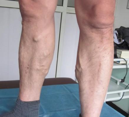 静脉曲张到底是什么？血管是不是很容易爆裂？容易溃疡？其实平时护理很重要，3个护理方法学起来，还你健康