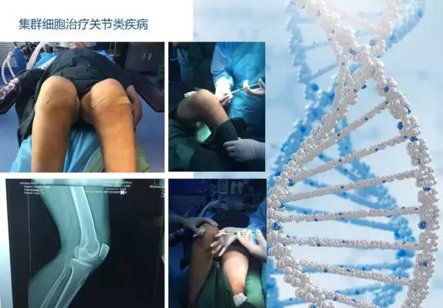 巨噬细胞衰老骨质疏松,成骨细胞会衰老吗