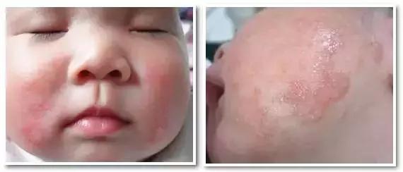 痱子不谨慎当湿疹治疗会怎么样,痱子小红点
