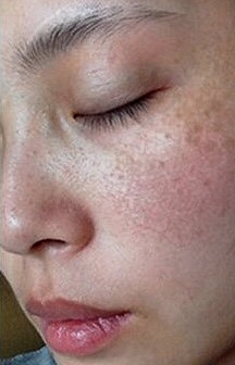 生孩子后脸色暗黄有斑怎么办,生孩子后长斑什么原因