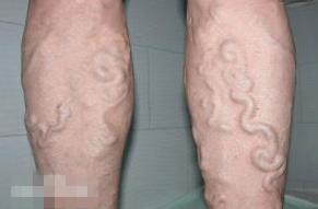 静脉曲张到底是什么？血管是不是很容易爆裂？容易溃疡？其实平时护理很重要，3个护理方法学起来，还你健康