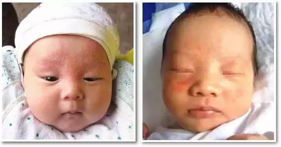 痱子不谨慎当湿疹治疗会怎么样,痱子小红点