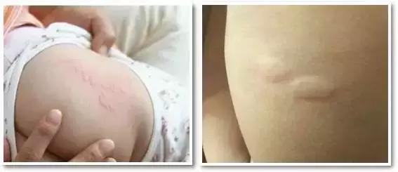 痱子不谨慎当湿疹治疗会怎么样,痱子小红点