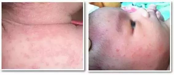 痱子不谨慎当湿疹治疗会怎么样,痱子小红点