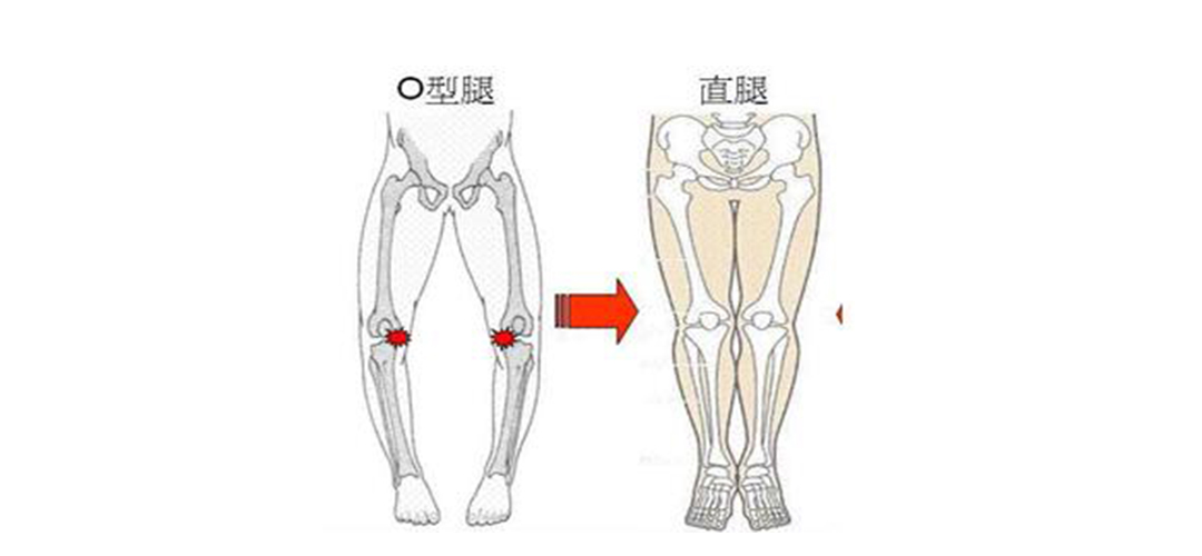 翘二郎腿导致腿部变形怎么矫正,翘二郎腿变形了有没有办法矫正