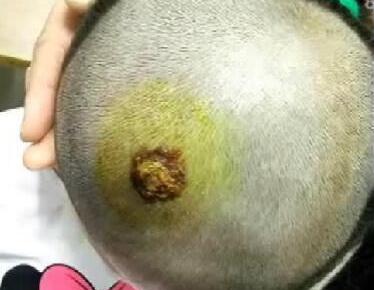 宝宝头上疙瘩说是过敏,宝宝头上起了小疹子是过敏吗