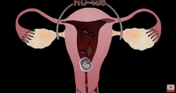 堕胎手术详细流程,女性堕胎手术的可怕真相