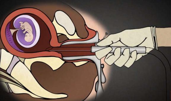 堕胎手术详细流程,女性堕胎手术的可怕真相