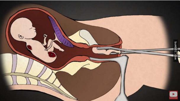堕胎手术详细流程,女性堕胎手术的可怕真相