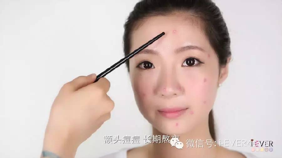 痘痘印快速搞定,痘坑痘印快速消