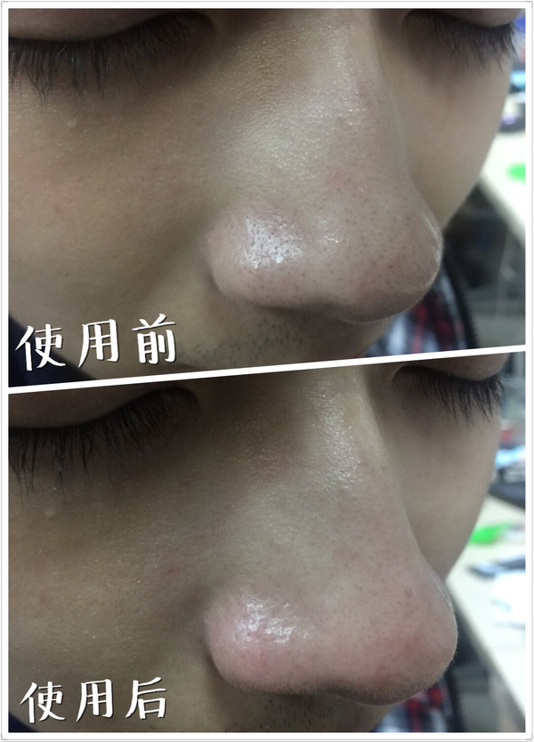 男士去除黑头,男士如何去除黑头的最有效方法