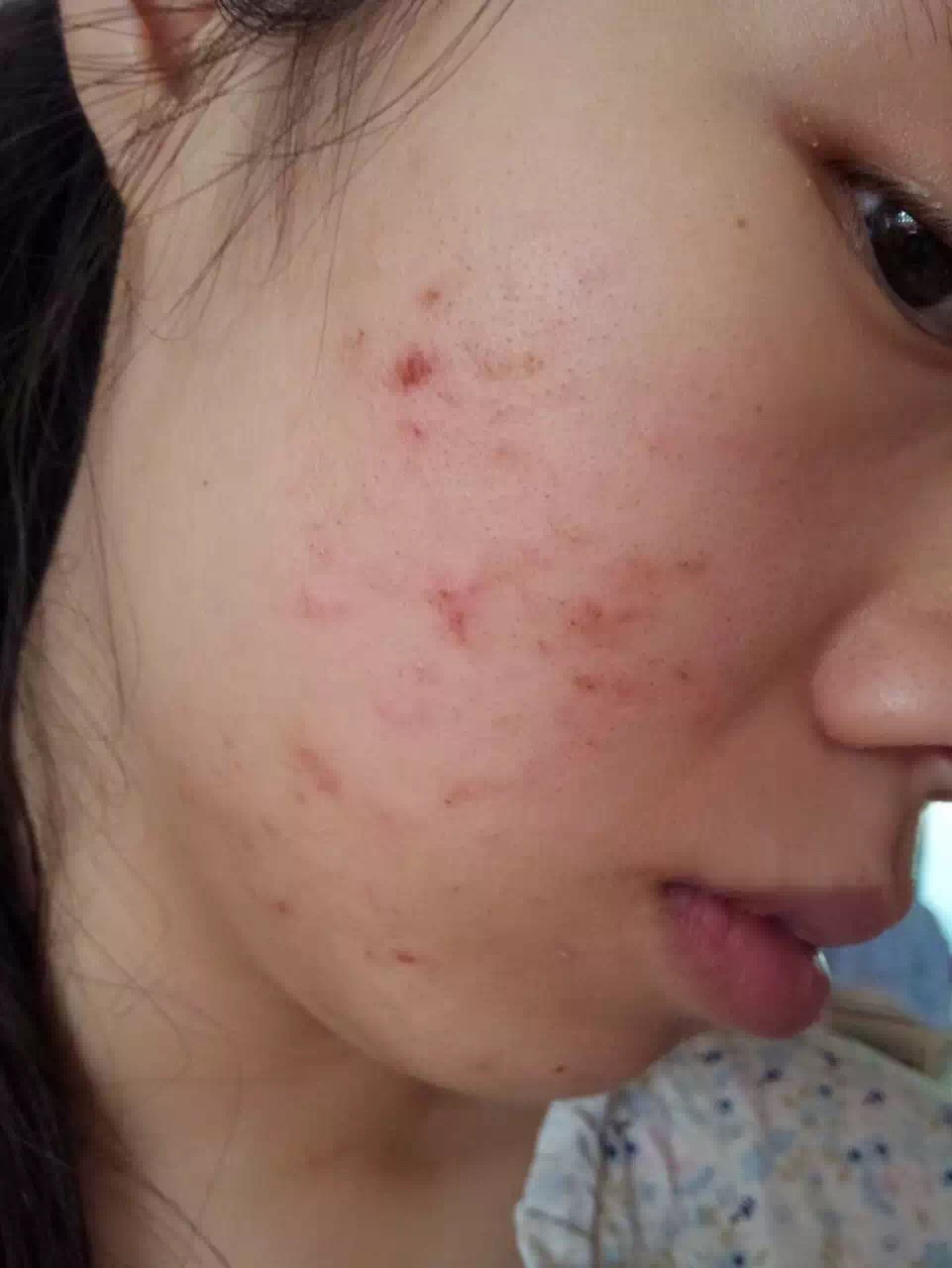 慎入！春季多发激素脸！你还要不要脸？