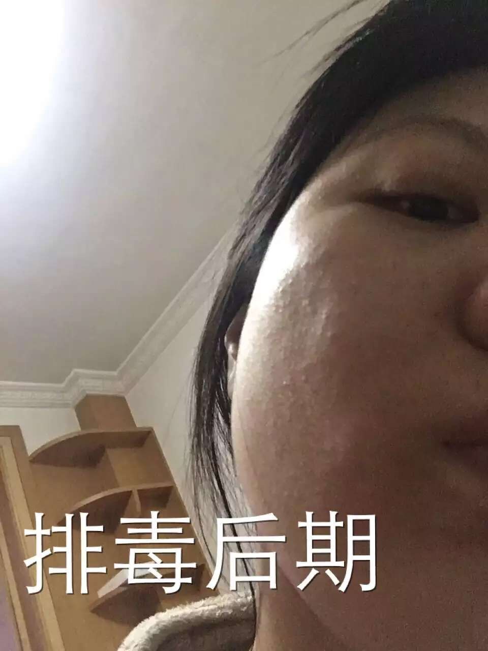 慎入！春季多发激素脸！你还要不要脸？