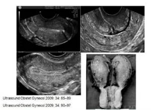 二胎如果怀在疤痕上有什么反应,二胎子宫疤痕薄能生三胎吗