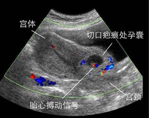 二胎如果怀在疤痕上有什么反应,二胎子宫疤痕薄能生三胎吗