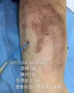 敷料致接触性皮炎，护士这样换药处理，效果极佳！