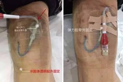 敷料致接触性皮炎，护士这样换药处理，效果极佳！