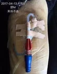 敷料致接触性皮炎，护士这样换药处理，效果极佳！