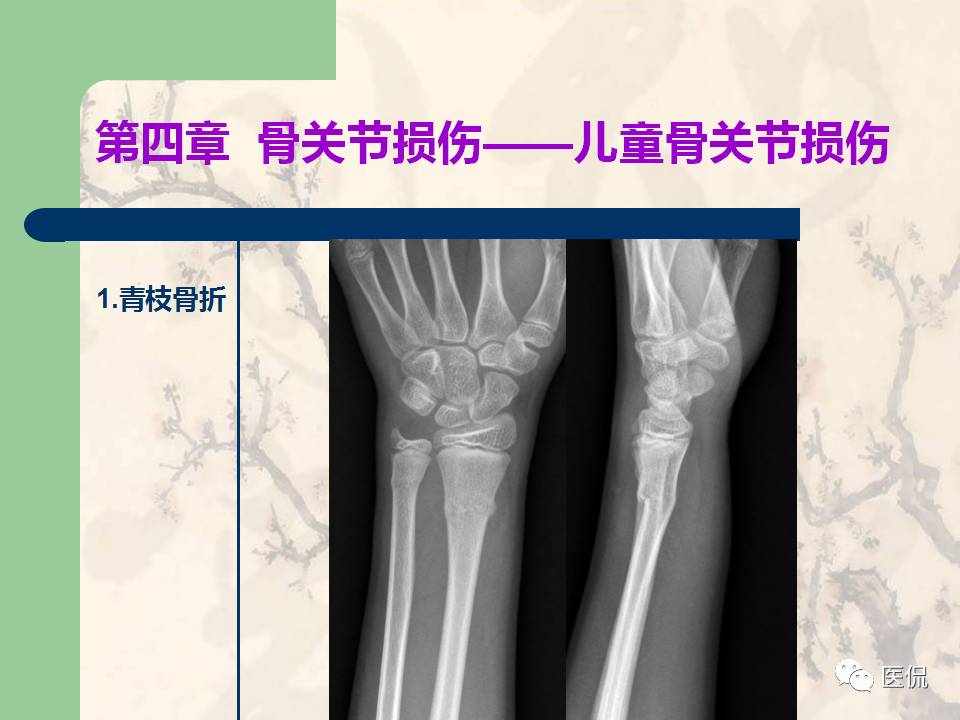 骨关节创伤x线诊断图谱,骨关节损伤x线图