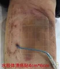 敷料致接触性皮炎，护士这样换药处理，效果极佳！