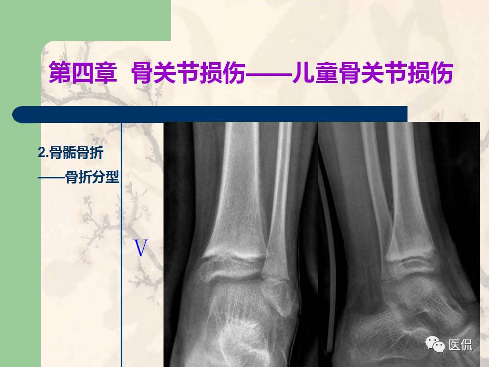 骨关节创伤x线诊断图谱,骨关节损伤x线图