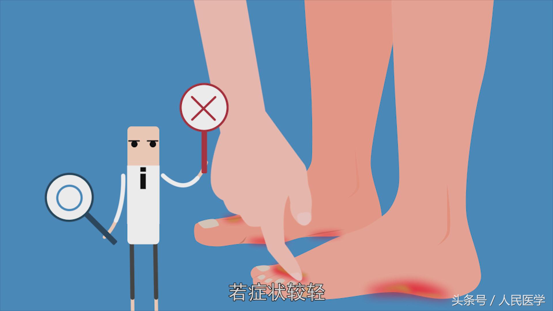 脚气被称作香港脚又叫什么,脚气与香港脚的区别