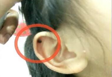 宝宝头上疙瘩说是过敏,宝宝头上起了小疹子是过敏吗