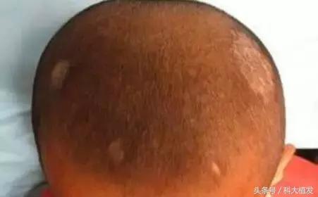 小孩不长头发,小孩不长头发怎么治疗