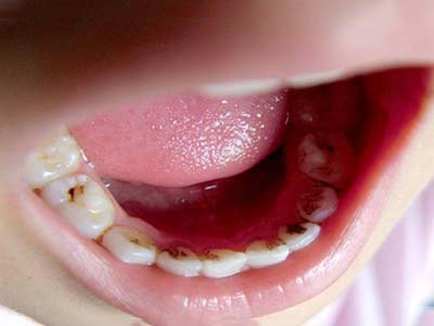 小孩牙齿地包天的原因,牙齿地包天是什么原因造成的