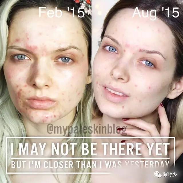 明星皮肤真的不长痘吗,脸上不长痘