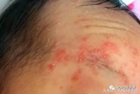 在树宝N次湿疹之后，我总结了这份战“痘”清单送给新手妈妈