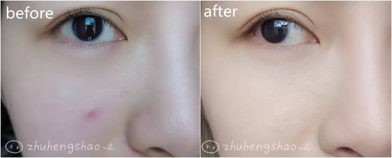 明星皮肤真的不长痘吗,脸上不长痘