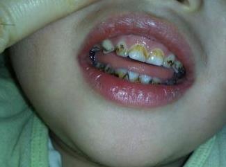 小孩牙齿地包天的原因,牙齿地包天是什么原因造成的