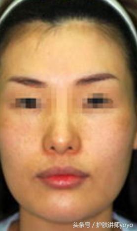 皮肤的皮脂膜受损怎么修复,皮脂膜受损皮肤干