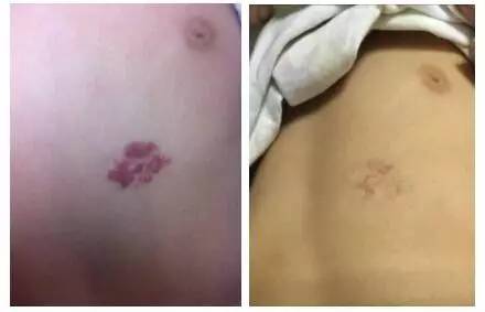 婴幼儿脸上有胎记怎么办,治疗婴幼儿红胎记哪里好