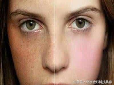 40岁脸上长斑怎么祛除最快,脸上长斑如何祛除黑色素