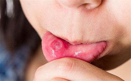 鼻子很油有痘怎么去,鼻子冒油长痘快速消除方法