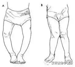 xo型腿怎么矫正和瘦腿,xo型腿怎么矫正视频