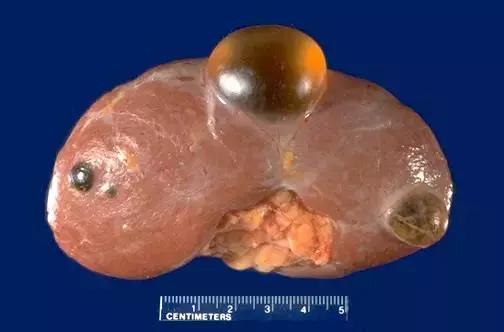 体检发现肾囊肿是什么征兆,体检发现肾囊肿该怎么办