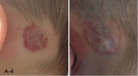 婴幼儿脸上有胎记怎么办,治疗婴幼儿红胎记哪里好