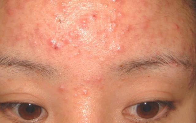 鼻子很油有痘怎么去,鼻子冒油长痘快速消除方法