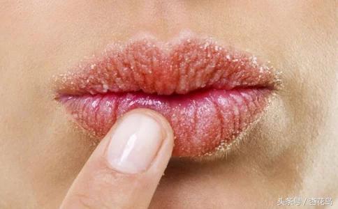 嘴得了唇炎该怎么办,慢性唇炎嘴唇肿胀怎么办