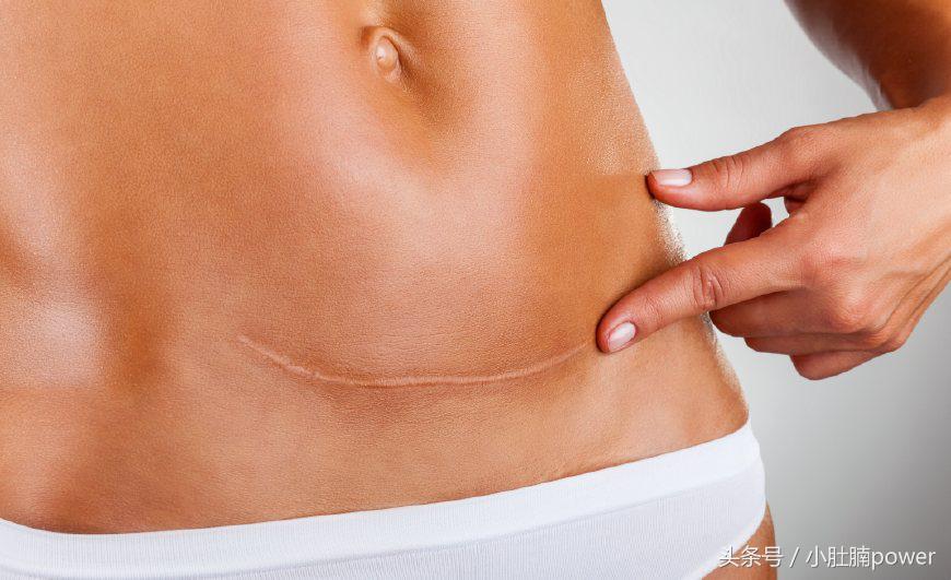 最简单有效的祛疤方法,两年的疤去疤小妙招